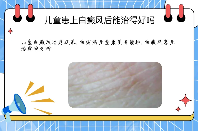 儿童患上白癜风后能治得好吗