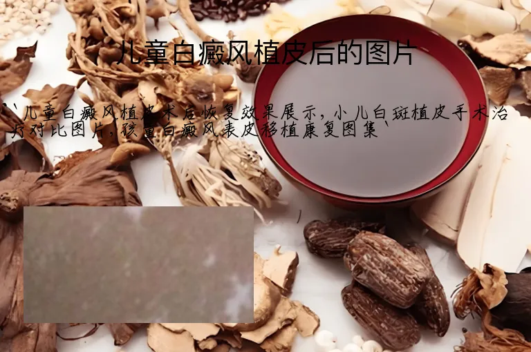 儿童白癜风植皮后的图片
