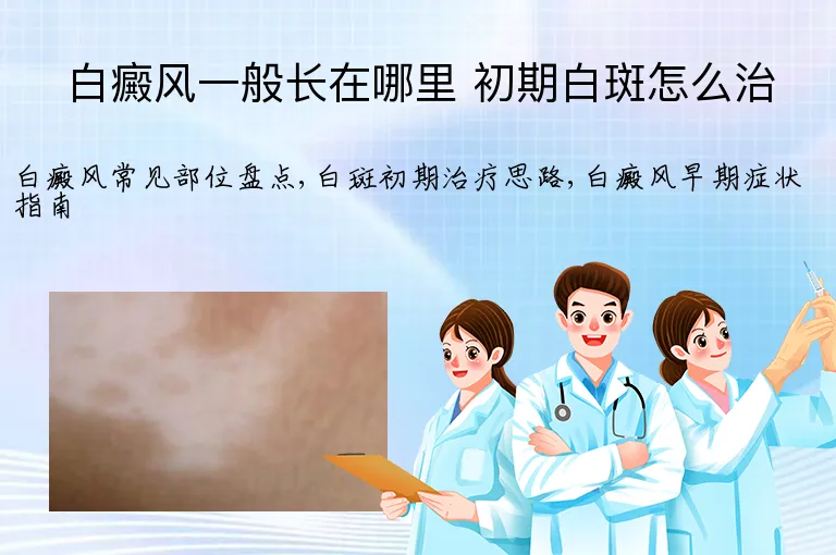 白癜风一般长在哪里 初期白斑怎么治
