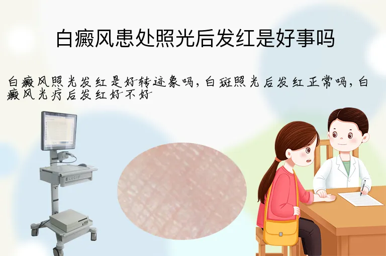 白癜风患处照光后发红是好事吗