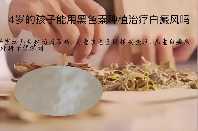 4岁的孩子能用黑色素种植治疗白癜风吗