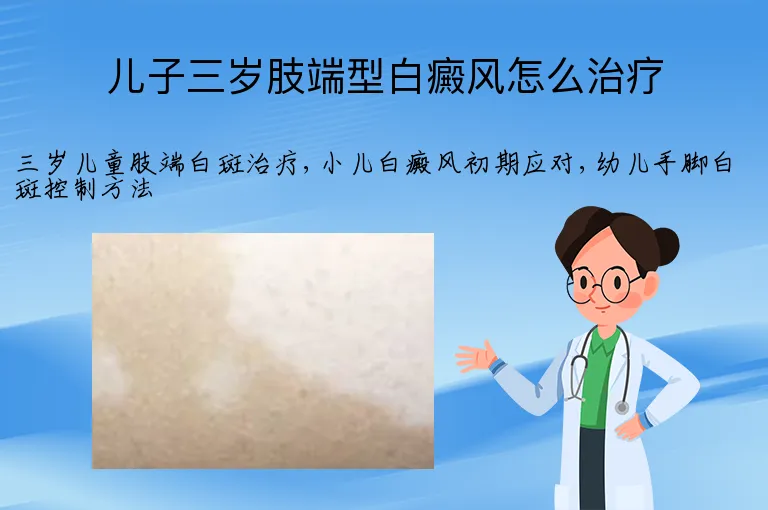 儿子三岁肢端型白癜风怎么治疗