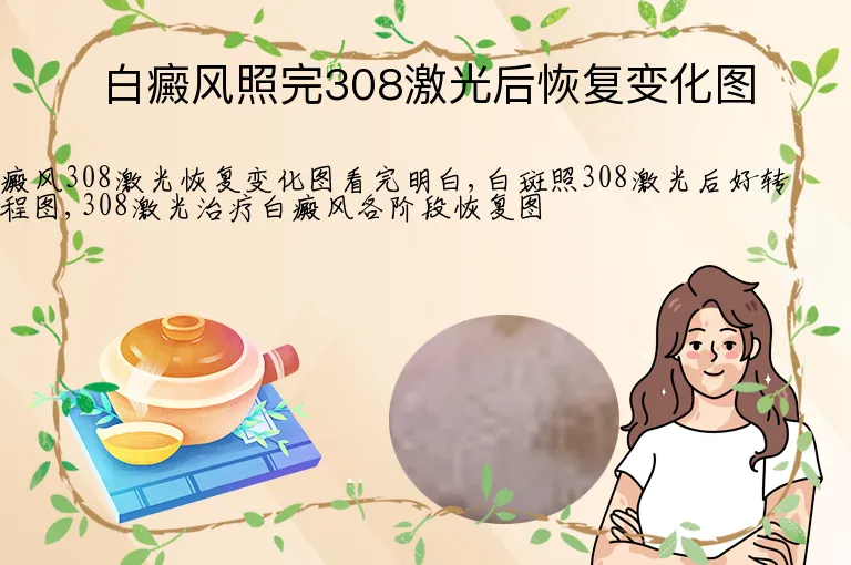 白癜风照完308激光后恢复变化图