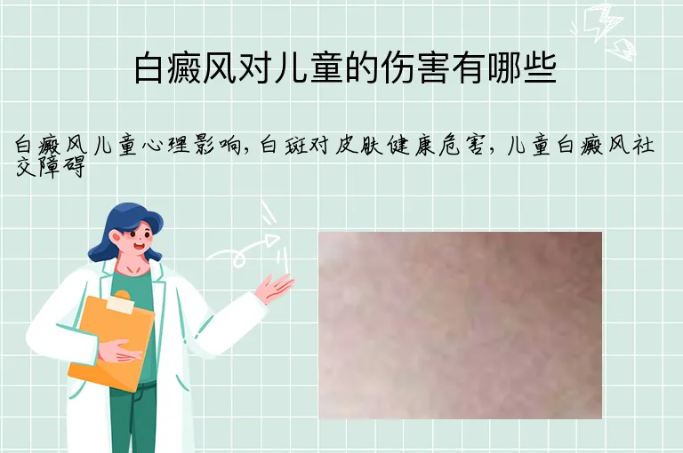 白癜风对儿童的伤害有哪些