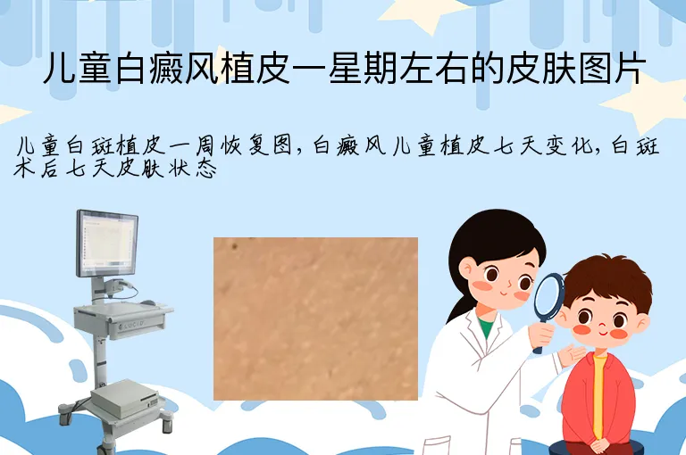 儿童白癜风植皮一星期左右的皮肤图片