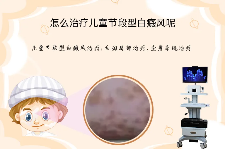 怎么治疗儿童节段型白癜风呢
