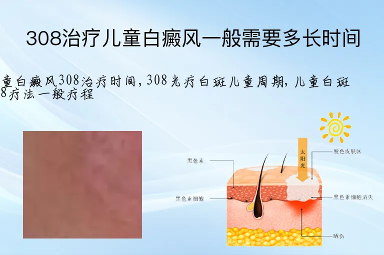 308治疗儿童白癜风一般需要多长时间