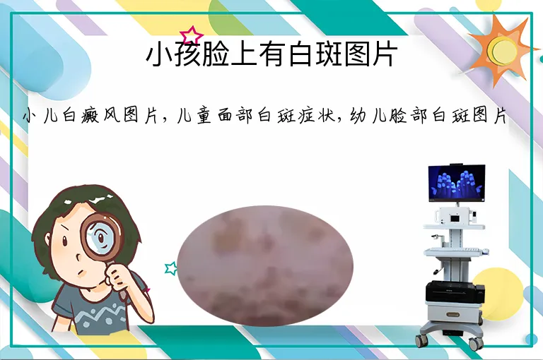 小孩脸上有白斑图片