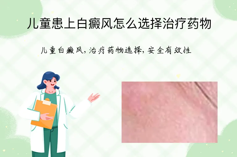 儿童患上白癜风怎么选择治疗药物