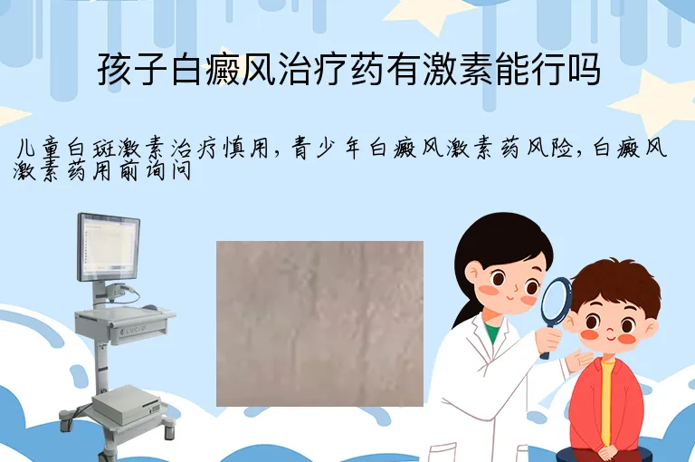 孩子白癜风治疗药有激素能行吗