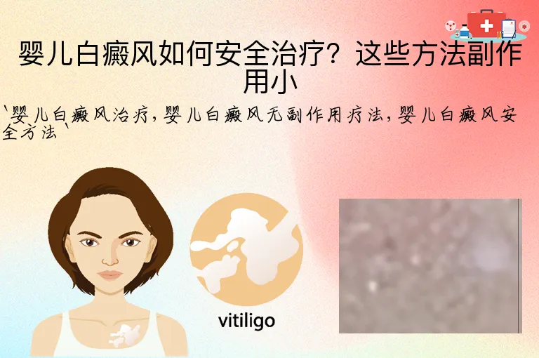 婴儿白癜风如何安全治疗？这些方法副作用小