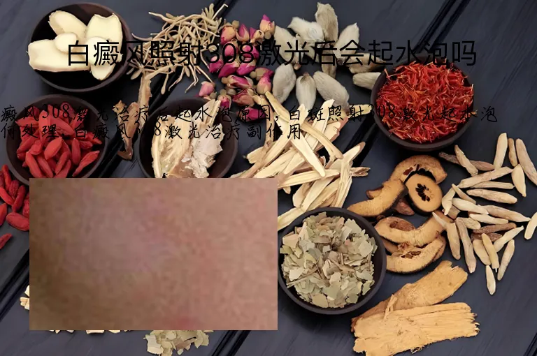 白癜风照射308激光后会起水泡吗