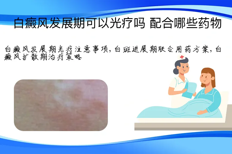 白癜风发展期可以光疗吗 配合哪些药物