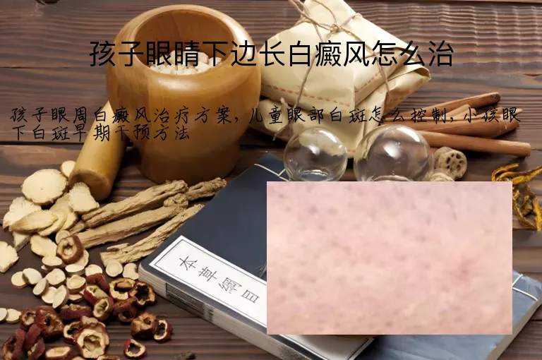 孩子眼睛下边长白癜风怎么治