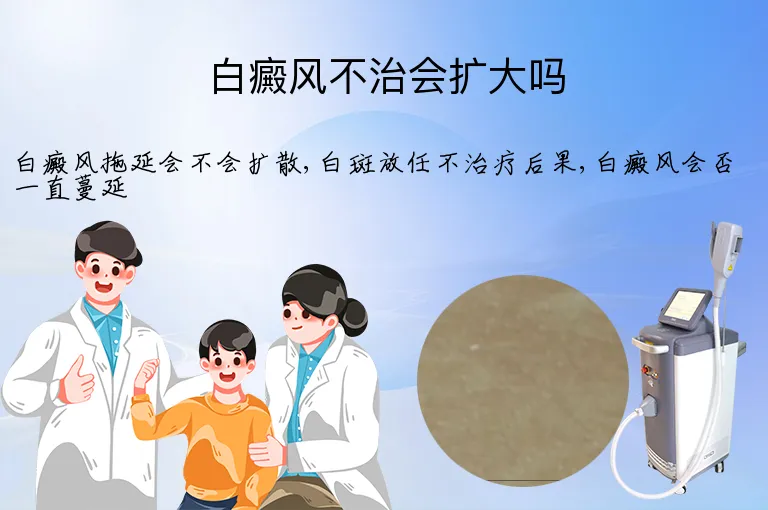 白癜风不治会扩大吗