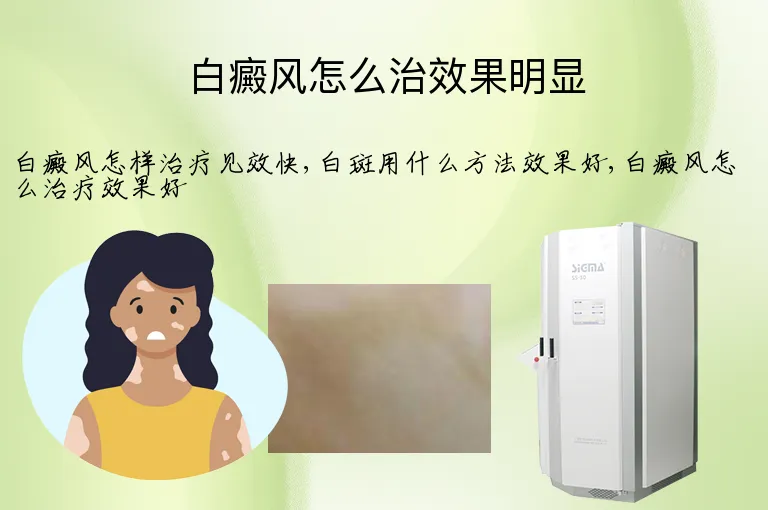 白癜风怎么治效果明显