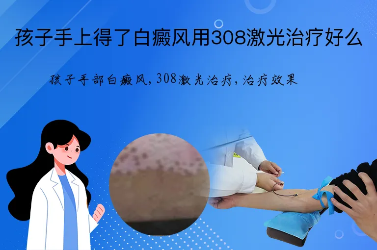 孩子手上得了白癜风用308激光治疗好么