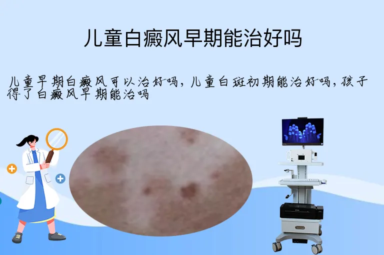 儿童白癜风早期能治好吗