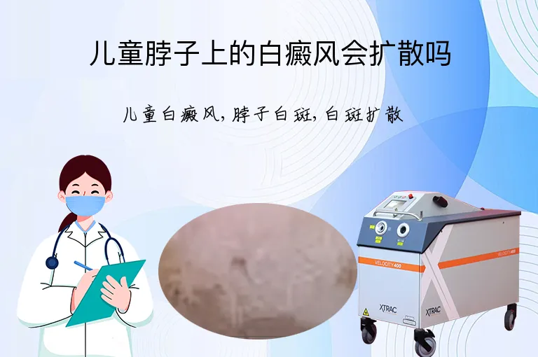 儿童脖子上的白癜风会扩散吗