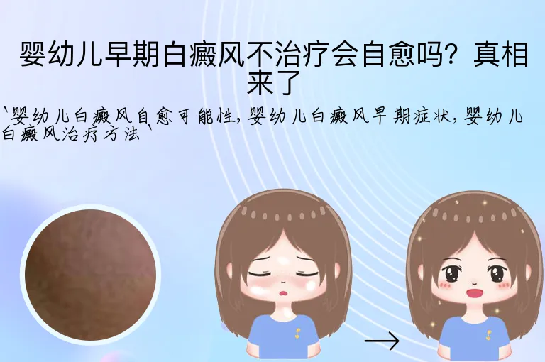 婴幼儿早期白癜风不治疗会自愈吗?真相来了