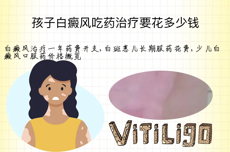 孩子白癜风吃药治疗要花多少钱