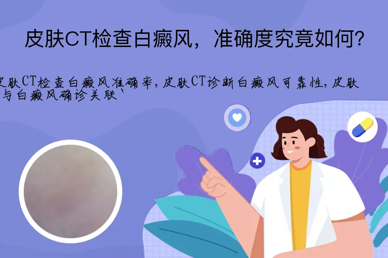 皮肤CT检查白癜风，准确度究竟如何？