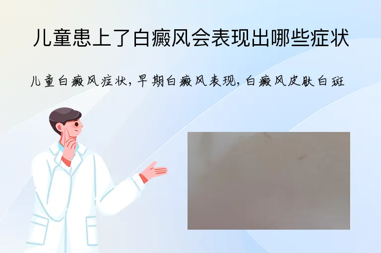 儿童患上了白癜风会表现出哪些症状