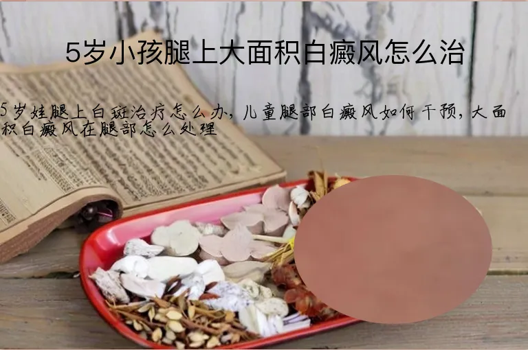 5岁小孩腿上大面积白癜风怎么治