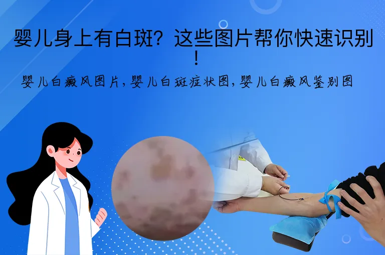 婴儿身上有白斑？这些图片帮你快速识别！