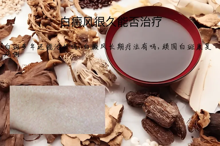 白癜风很久能否治疗