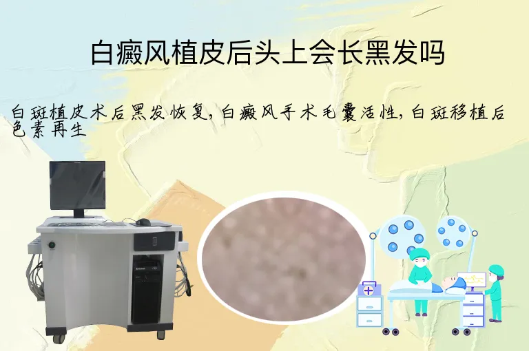 白癜风植皮后头上会长黑发吗