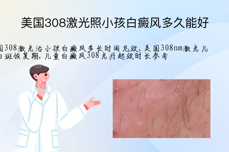 美国308激光照小孩白癜风多久能好