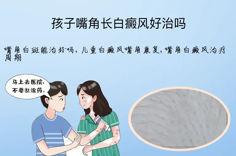 孩子嘴角长白癜风好治吗