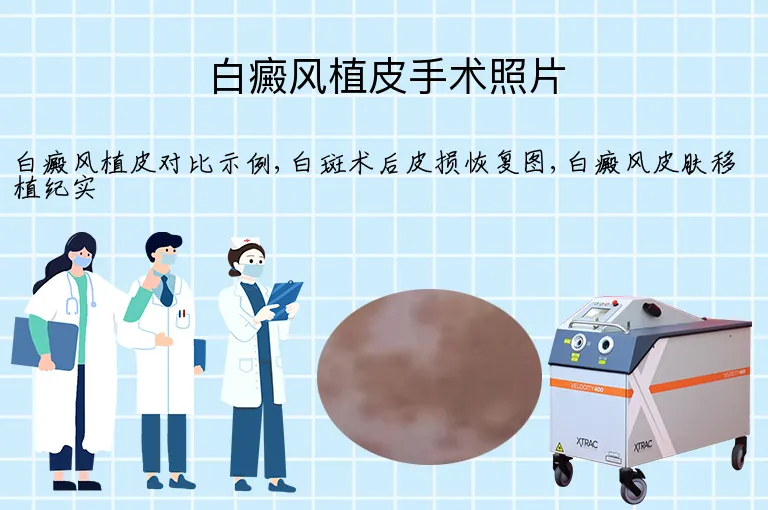白癜风植皮手术照片