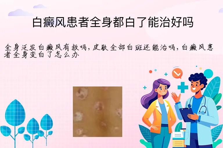 白癜风患者全身都白了能治好吗