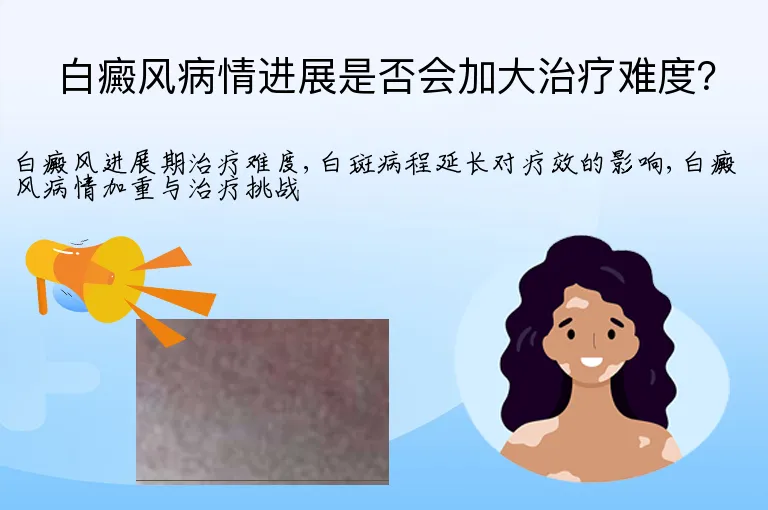 白癜风病情进展是否会加大治疗难度？