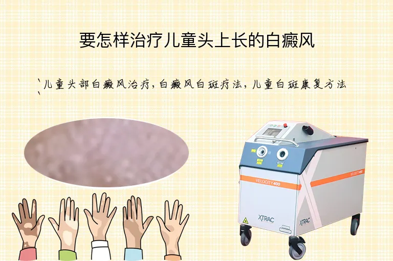 要怎样治疗儿童头上长的白癜风