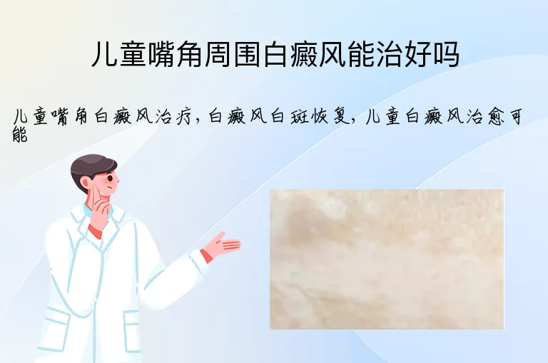 儿童嘴角周围白癜风能治好吗