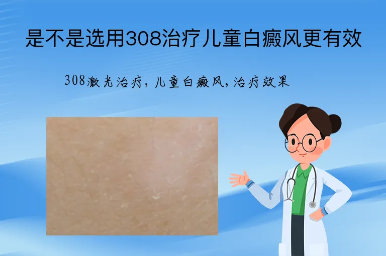 是不是选用308治疗儿童白癜风更有效