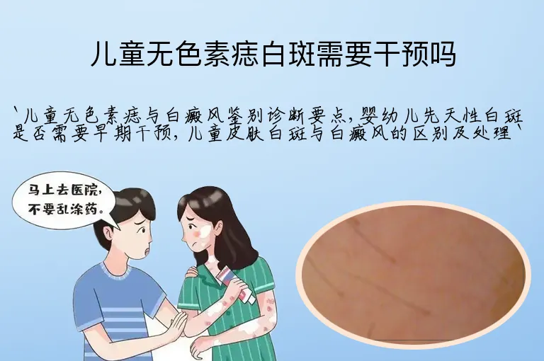 儿童无色素痣白斑需要干预吗