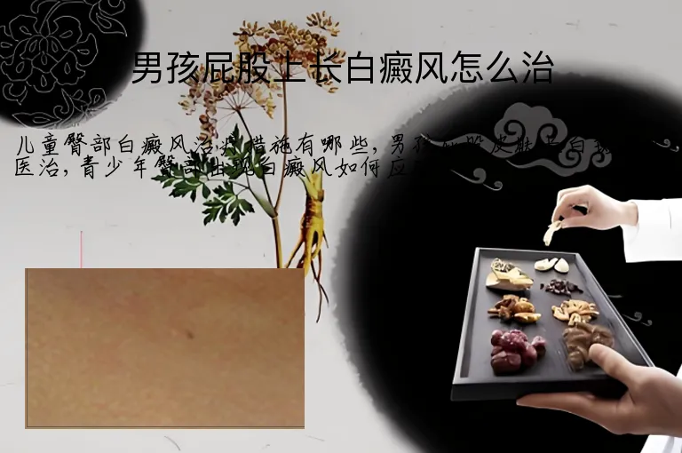 男孩屁股上长白癜风怎么治