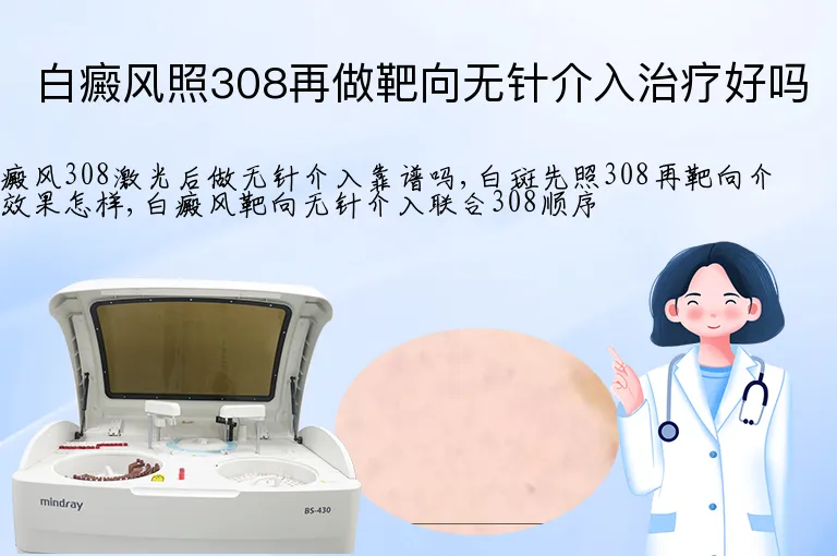 白癜风照308再做靶向无针介入治疗好吗