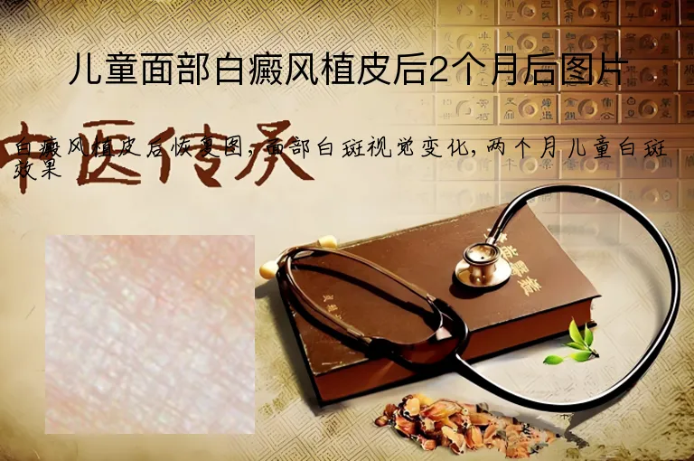 儿童面部白癜风植皮后2个月后图片