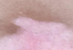 白癜风的症状有哪些？白癜风患者需谨记这3点，好好护理