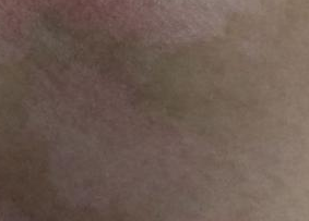 白癜风的症状特点是怎样的呢？