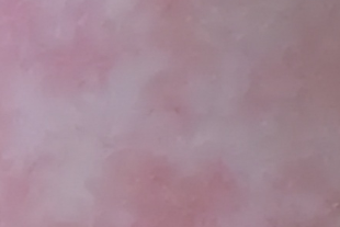 白癜风发病特征有哪些？你知道几点？