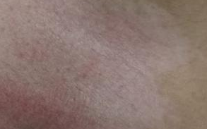 患上白癜风会出现哪些症状？