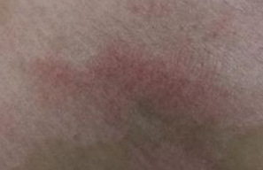 白癜风的常见症状有哪些?
