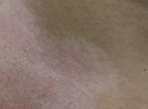 白癜风的症状都有哪些？