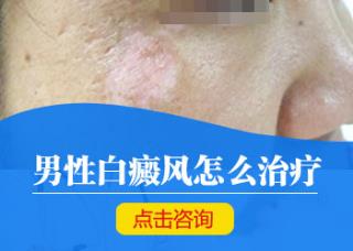 白癜风易发部位病发的缘由是什么